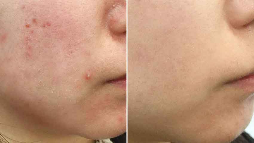 AHA%2C-BHA%2C-PHA-30-Days-Miracle-Cleans