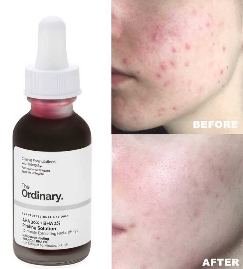 The-Ordinary-AHA-30%25-BHA-2%25-Peeling-